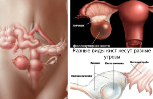 Киста яичника и беременность возможна