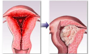 Гиперплазия эндометриоза матки