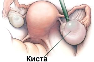 Беременность после удаления кисты яичника