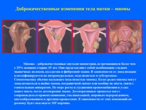 Лечение гомеопатией миомы матки