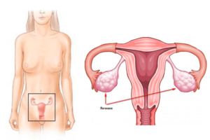 Патология гормонов яичников