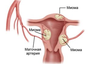 Спираль при миоме