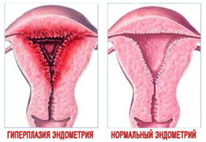 Гиперплазия эндометрия и эндометриоз это одно и то же