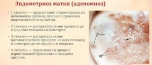 Эндометриоз шейки матки симптомы и лечение