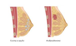 Беременность и фиброаденома молочной железы