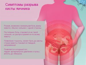 Симптомы разрыва кисты яичника у женщин