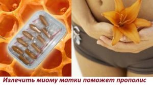Лечение миомы матки прополисом