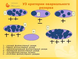 Снижение фолликулярного резерва яичников