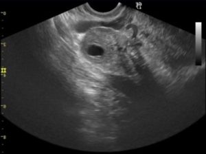 В правом яичнике желтое тело при беременности
