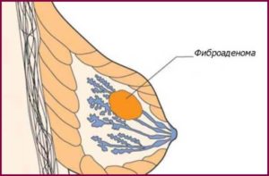 Аденома фиброма молочной железы