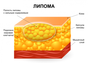 Фибролипома молочной железы что это такое