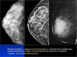 Как часто можно делать маммографию молочных желез после 50 лет