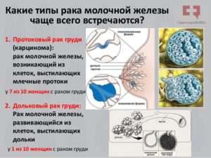 Рак молочной железы разновидности и признаки