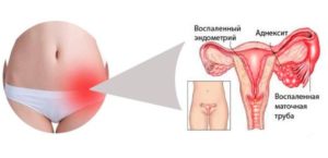 Воспаление левого яичника симптомы лечение