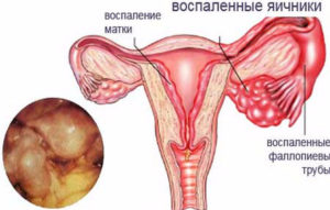 Воспаление правого яичника симптомы