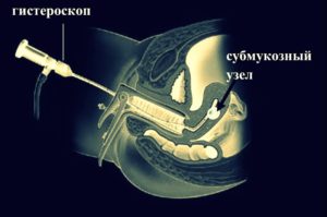 Удаление миомы матки гистероскопия