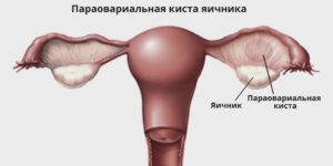 Параовариальная киста яичника лечение без операции