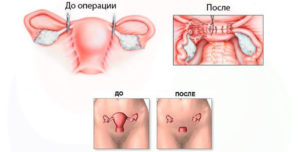 Климакс сколько длится после удаления матки