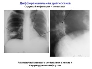 Метастазы в легких после рака молочной железы прогноз