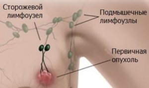 Лимфоузел в молочной железе что это такое