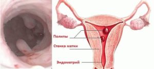 Гиперплазия яичников что это такое