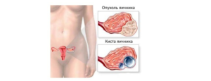 Метастазы в яичниках прогноз