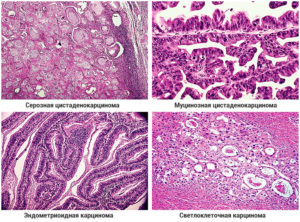Серозная карцинома яичника