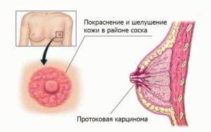 Рак соска молочной железы