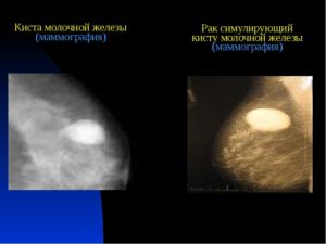 Как отличить кисту молочной железы от рака