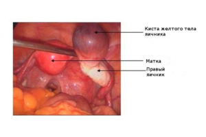 От чего киста бывает на яичнике