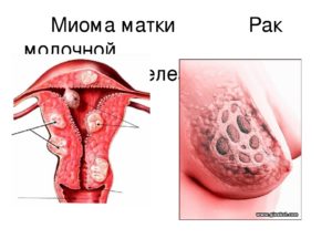 Миома матки перерождается ли в рак