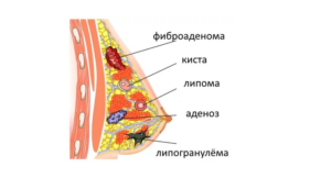 Липоматоз молочных желез