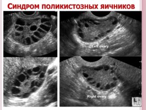 Синдром поликистозных яичников спкя