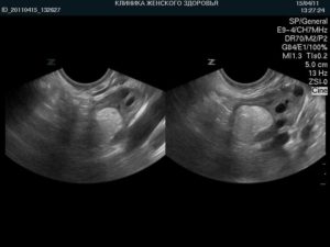 Лечение фиброма яичника