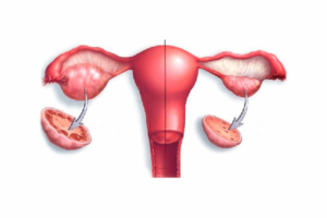 Нарушение функции яичников у женщин