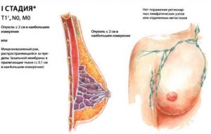 Симптомы рака молочной железы на ранней стадии