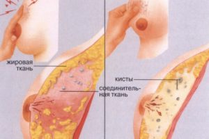 Уплотнение в молочной железе лечение народными средствами