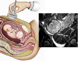 Беременность и миома матки малых размеров
