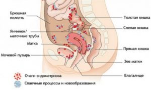Эндометриоз толстой кишки симптомы