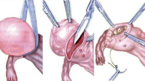 Лапароскопия параовариальной кисты яичника