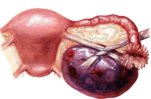 Киста яичника последствия после операции