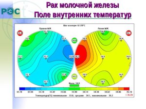 Радиотермометрия молочных желез где сделать