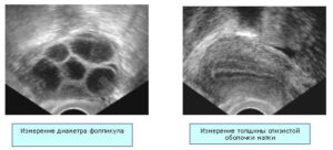 Сколько фолликулов должно быть в яичнике при эко