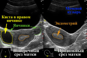 Как называется узи яичников и матки