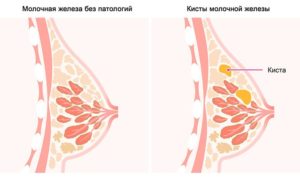 Может ли киста в молочной железе болеть