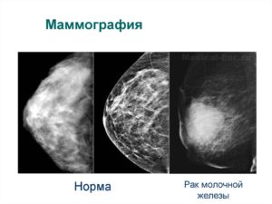 Что эффективнее узи или маммография молочных желез