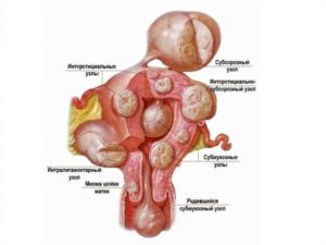 Миома матки серозная