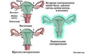 Удаление матки и яичников как называется операция