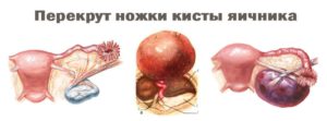 Лечение антибиотиками кисты яичника