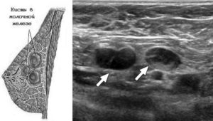 Как быстро растет киста молочной железы